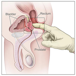 How to Find the Prostate