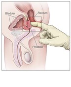 How to Find the Prostate